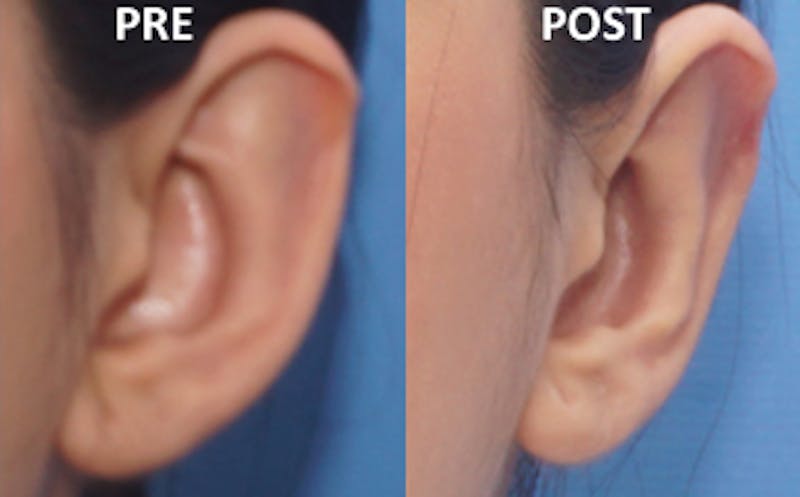Ear Surgery Before & After Gallery - Patient 140817 - Image 3