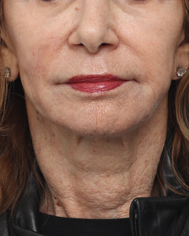 Facelift Before & After Gallery - Patient 710147 - Image 7