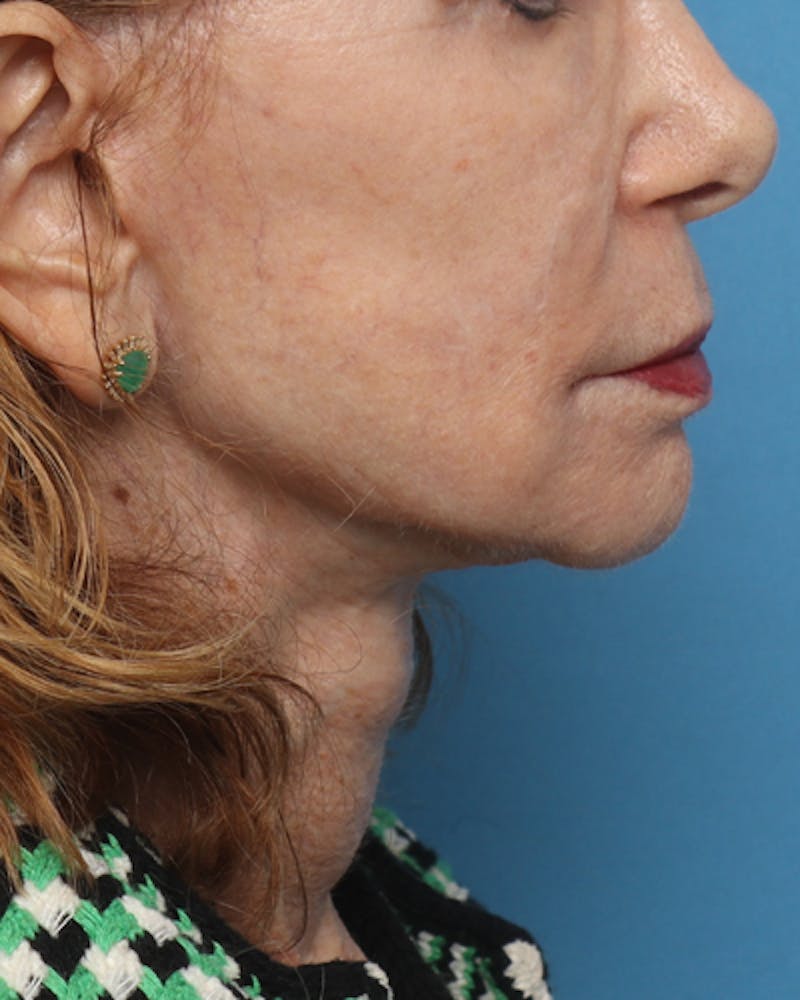 Facelift Before & After Gallery - Patient 710147 - Image 4