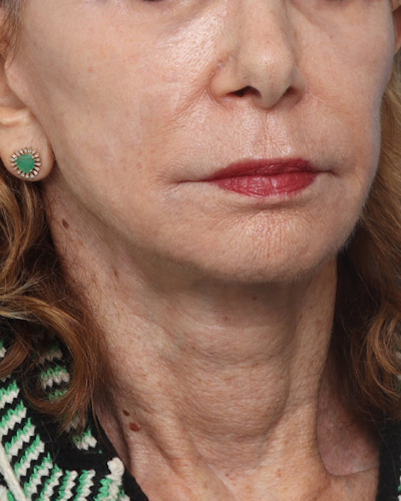 Facelift Before & After Gallery - Patient 710147 - Image 6