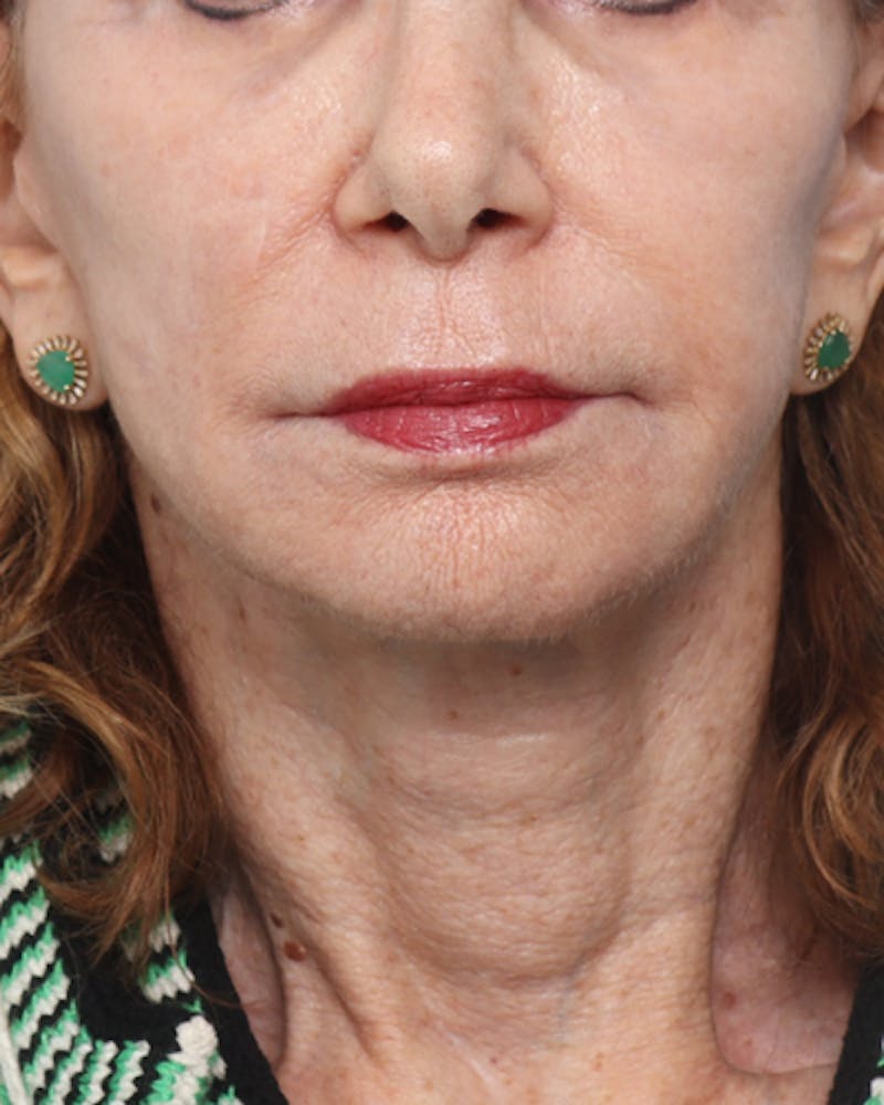 Facelift Before & After Gallery - Patient 710147 - Image 8