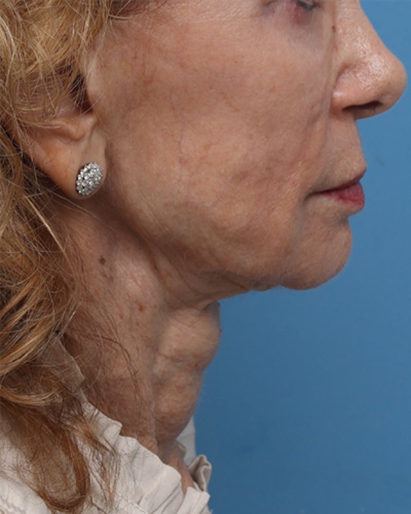 Facelift Before & After Gallery - Patient 710147 - Image 3