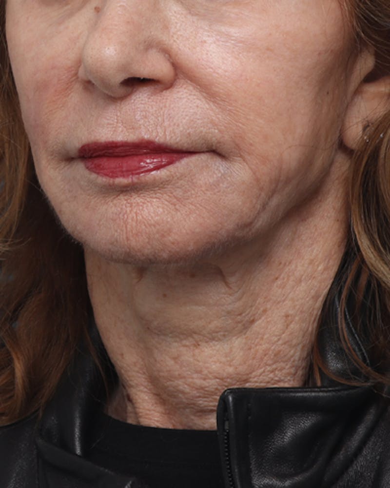 Patient N0RrAx1STbO6sY1ZaTGieg - Facelift Before & After Photos