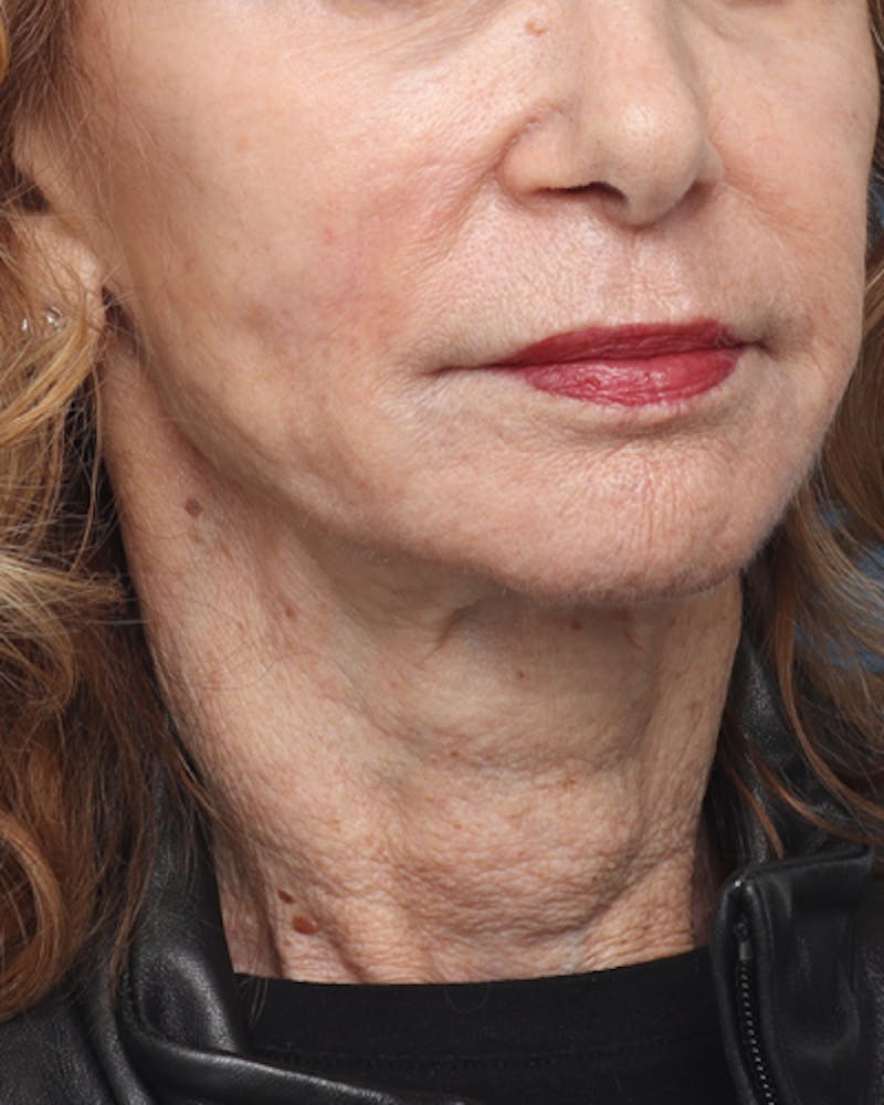 Facelift Before & After Gallery - Patient 710147 - Image 5