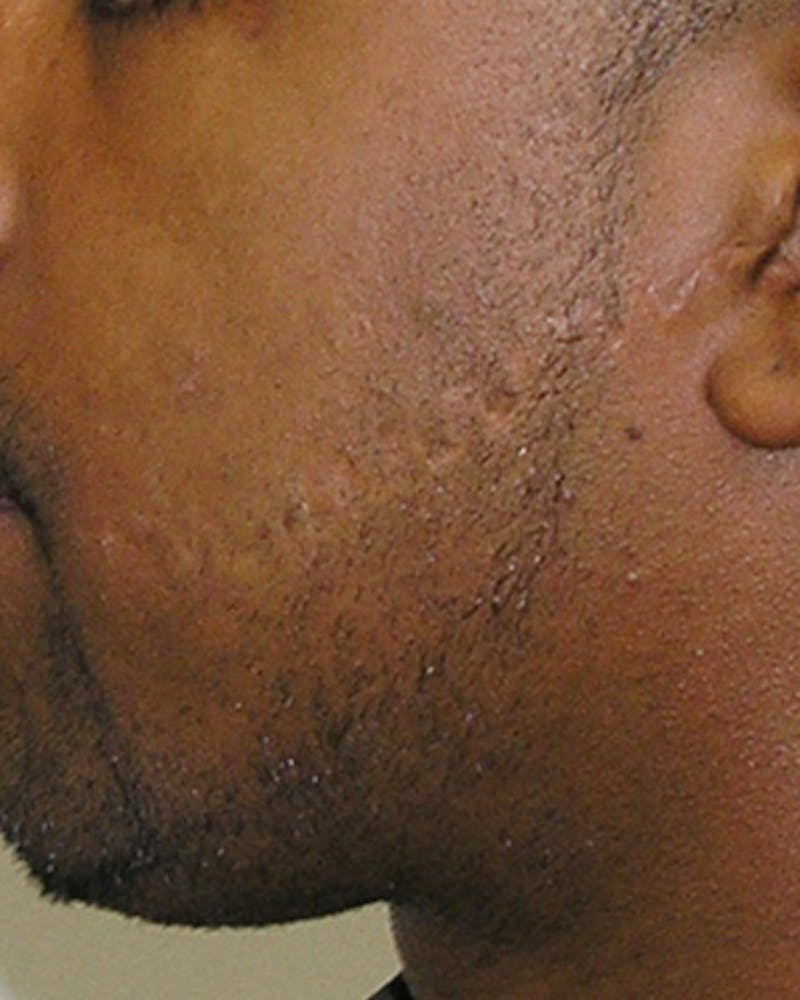 Scar Revision Before & After Gallery - Patient 312423 - Image 4
