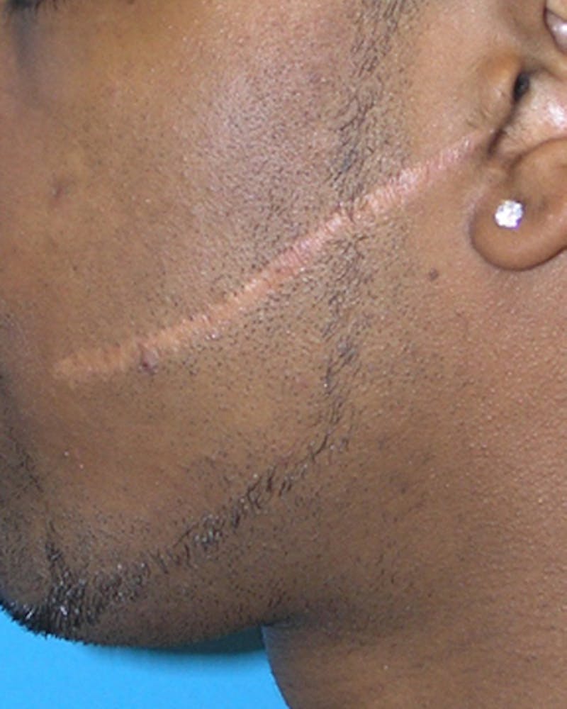 Scar Revision Before & After Gallery - Patient 312423 - Image 3