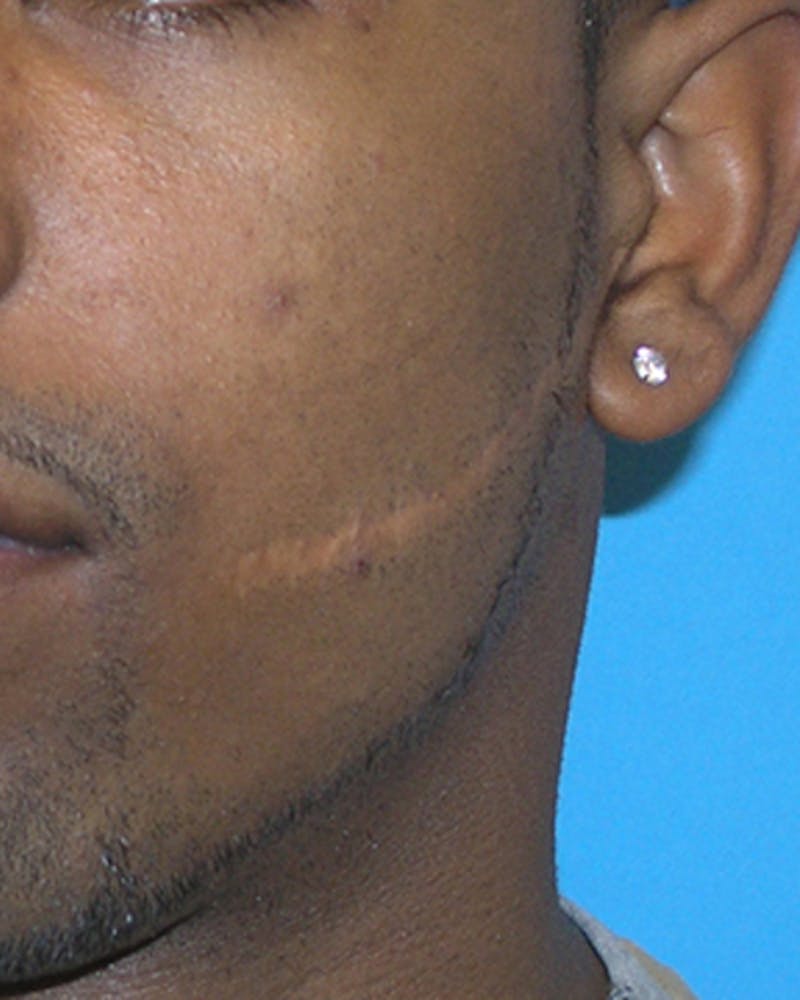 Patient HJ8_IXa4T3yQItNR1PI-_w - Scar Revision Before & After Photos