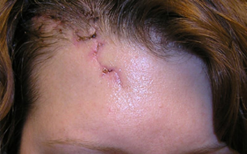 Patient OFIFHfqHQOC3A1CaPLKCqg - Scar Revision Before & After Photos