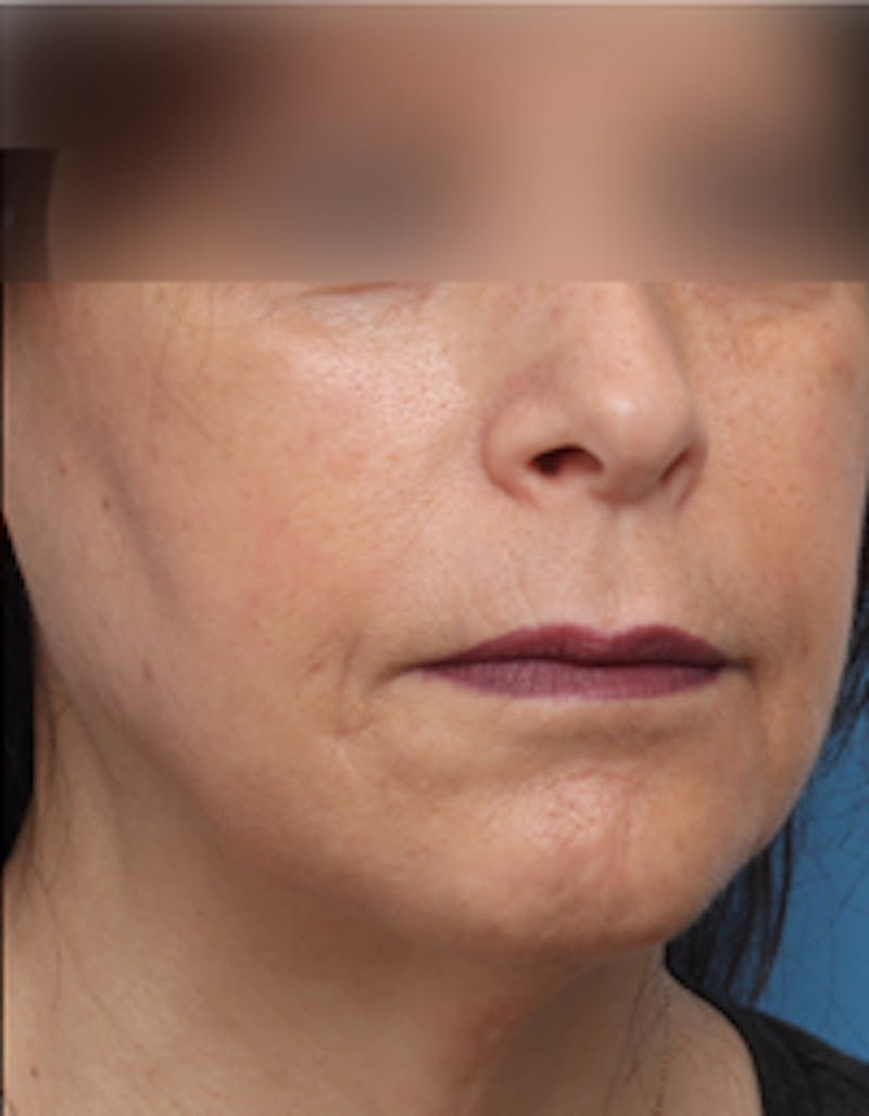 Fat Transfer Before & After Gallery - Patient 297582 - Image 4