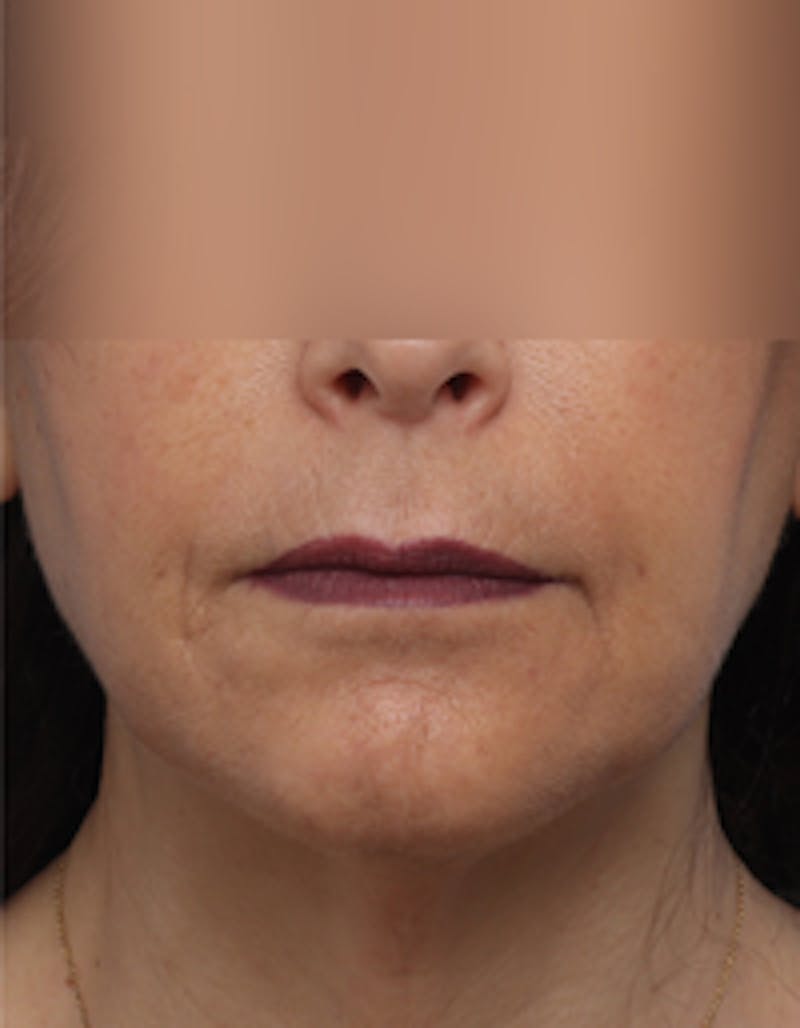 Fat Transfer Before & After Gallery - Patient 297582 - Image 6