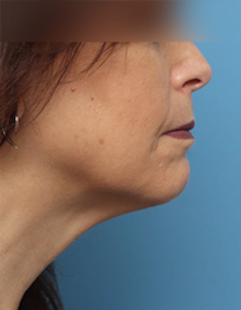 Fat Transfer Before & After Gallery - Patient 297582 - Image 8