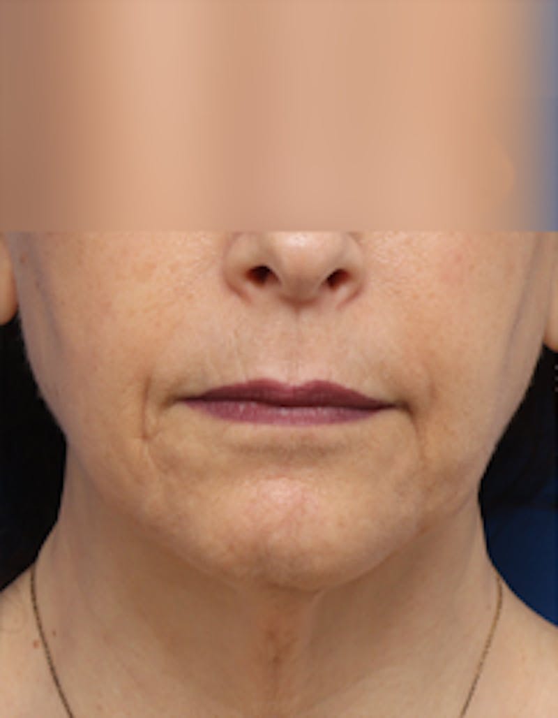 Fat Transfer Before & After Gallery - Patient 297582 - Image 5
