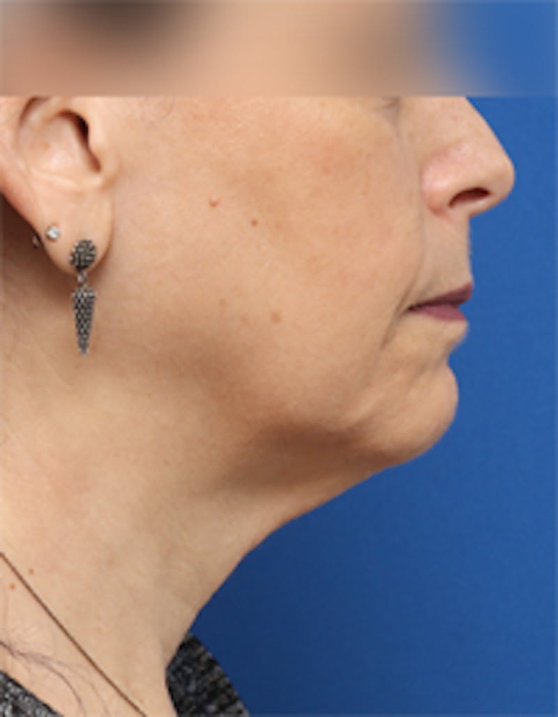 Fat Transfer Before & After Gallery - Patient 297582 - Image 7