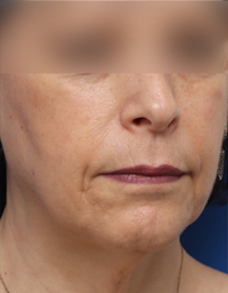 Fat Transfer Before & After Gallery - Patient 297582 - Image 3