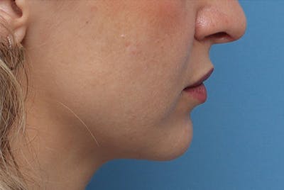 Chin Surgery Before & After Gallery - Patient 872425 - Image 1