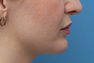 Chin Surgery Before & After Gallery - Patient 872425 - Image 2