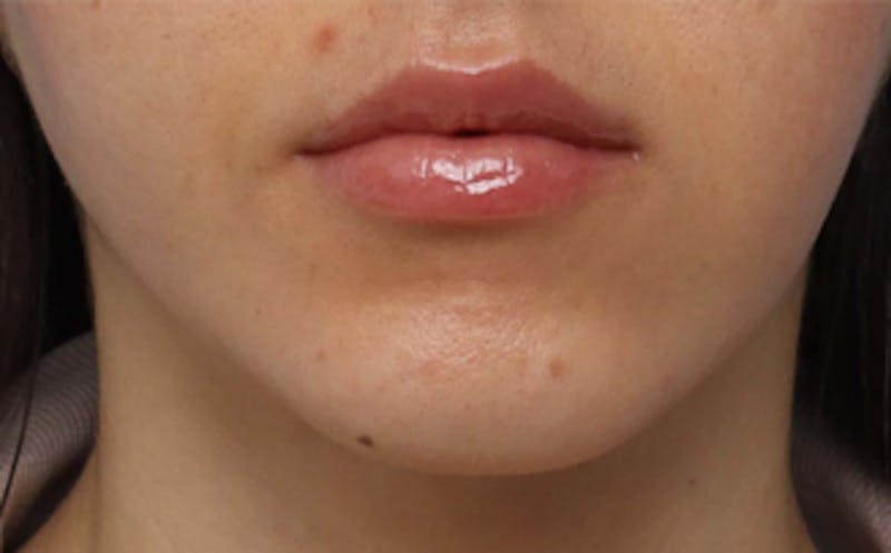 Fat Transfer Before & After Gallery - Patient 624912 - Image 8