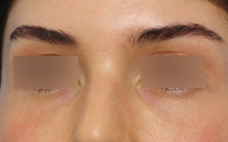 Fat Transfer Before & After Gallery - Patient 624912 - Image 4
