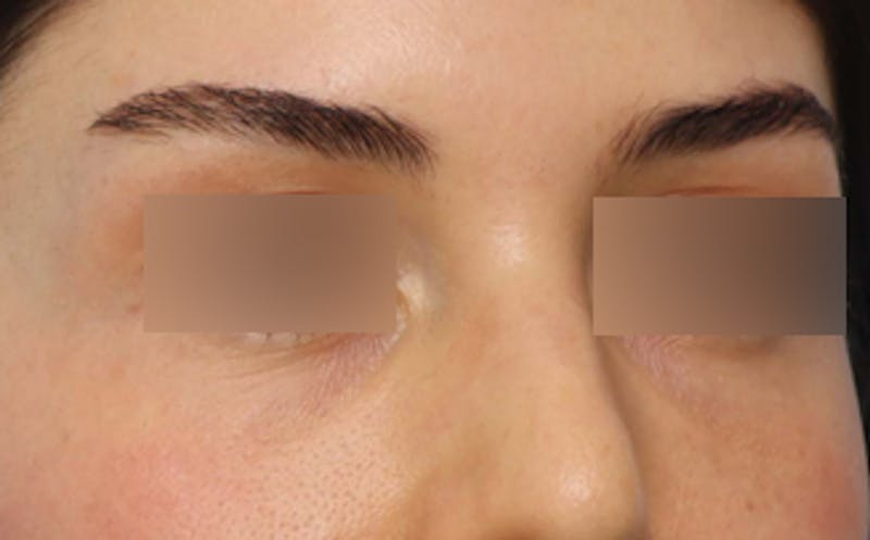 Fat Transfer Before & After Gallery - Patient 624912 - Image 6