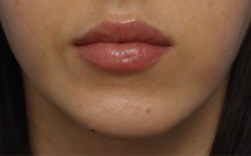 Fat Transfer Before & After Gallery - Patient 624912 - Image 7