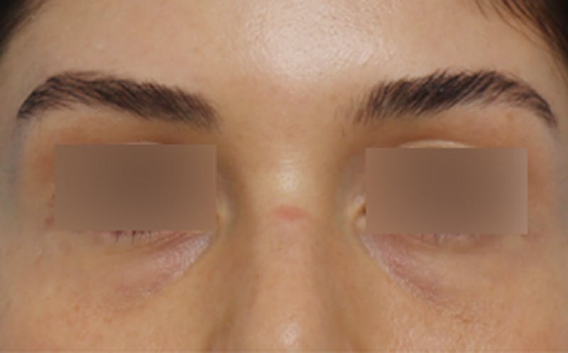 Patient fBEtML4mQzOh_G7urxw3gQ - Facial Fat Transfer Before & After Photos