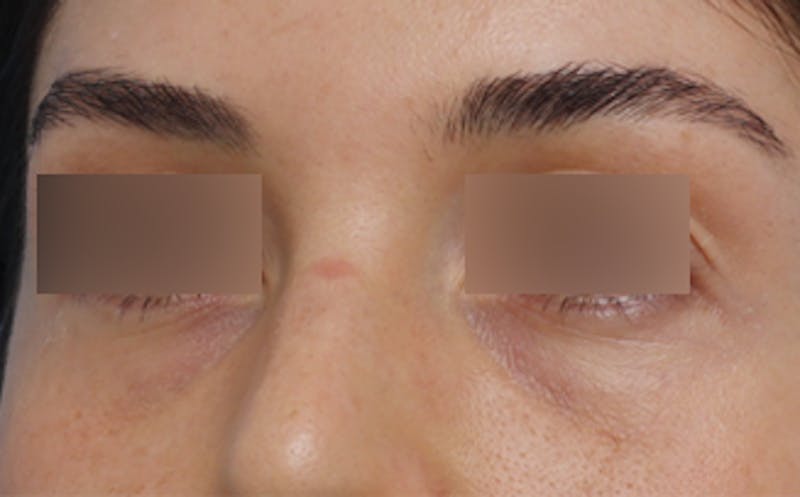 Fat Transfer Before & After Gallery - Patient 624912 - Image 3
