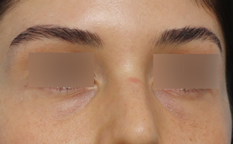 Fat Transfer Before & After Gallery - Patient 624912 - Image 5