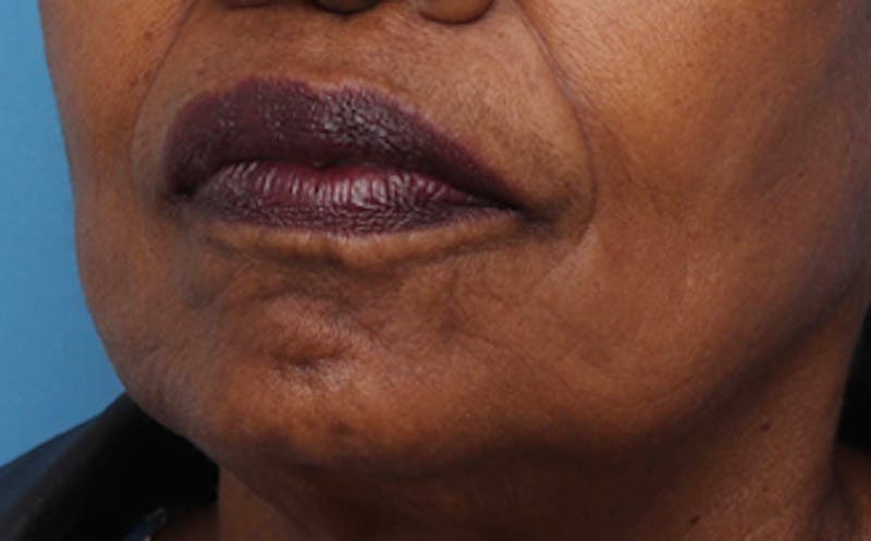 Fat Transfer Before & After Gallery - Patient 559853 - Image 6