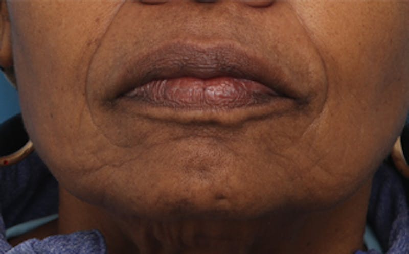 Patient eZhRvLbaSSujhF7oaetovQ - Facial Fat Transfer Before & After Photos