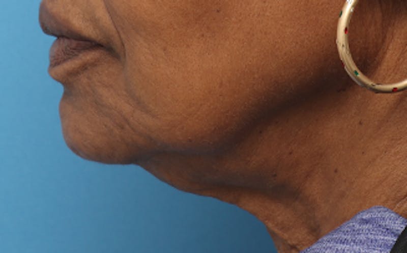 Fat Transfer Before & After Gallery - Patient 559853 - Image 7