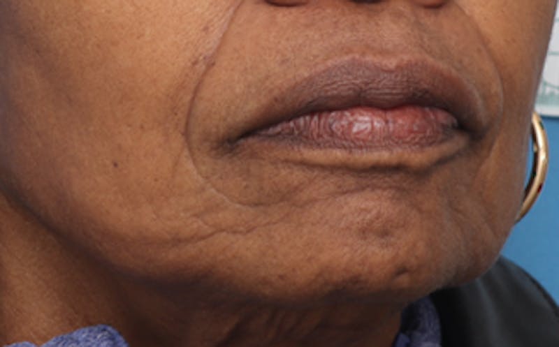 Fat Transfer Before & After Gallery - Patient 559853 - Image 3