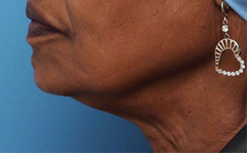 Fat Transfer Before & After Gallery - Patient 559853 - Image 8