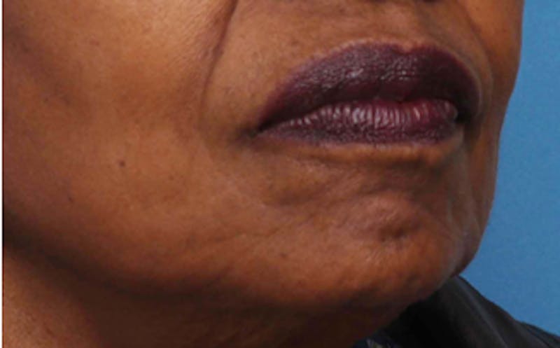 Fat Transfer Before & After Gallery - Patient 559853 - Image 4
