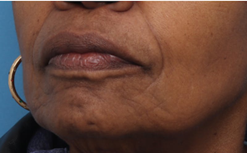Fat Transfer Before & After Gallery - Patient 559853 - Image 5