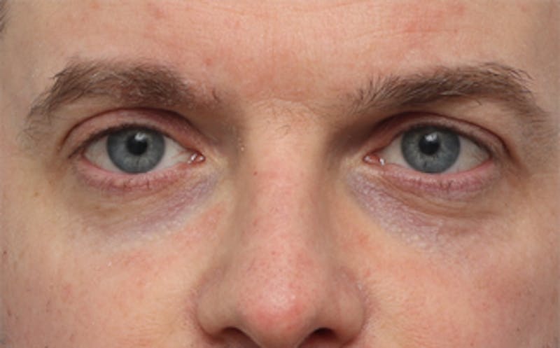 Fat Transfer Before & After Gallery - Patient 238152 - Image 3