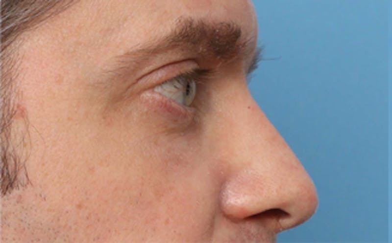 Fat Transfer Before & After Gallery - Patient 238152 - Image 8