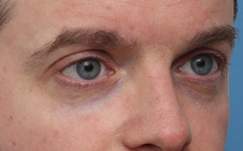 Patient NwxsdmIPT7GoXCUyUcu7Uw - Facial Fat Transfer Before & After Photos