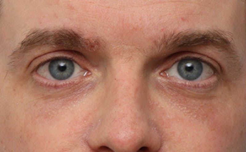 Fat Transfer Before & After Gallery - Patient 238152 - Image 4