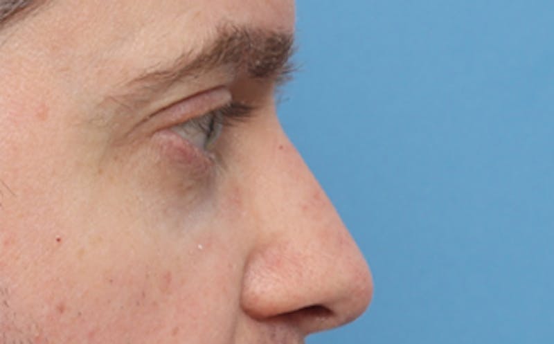 Fat Transfer Before & After Gallery - Patient 238152 - Image 7