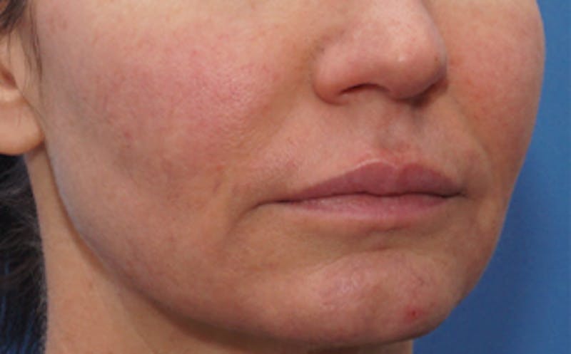 Patient bneovzHURuCvPZ69QN_QWQ - IPL Treatment Before & After Photos