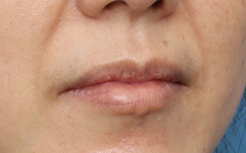Lip Surgery Before & After Gallery - Patient 362755 - Image 6