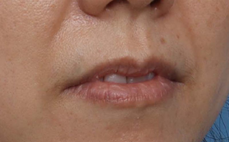 Lip Surgery Before & After Gallery - Patient 362755 - Image 5