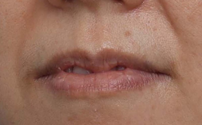 Lip Surgery Before & After Gallery - Patient 362755 - Image 3