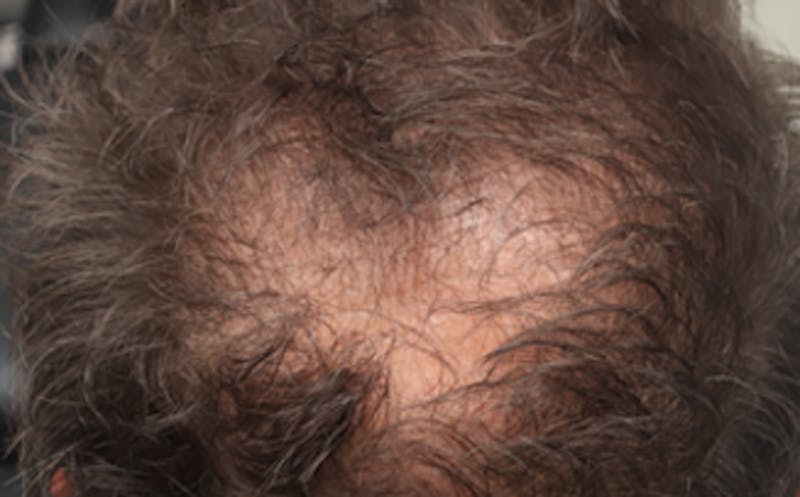 Patient O7nUbL6zSMyqz-pvjbTOYg - Hair Restoration Before & After Photos