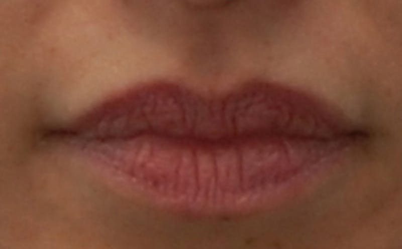 Lip Surgery Before & After Gallery - Patient 100740 - Image 3