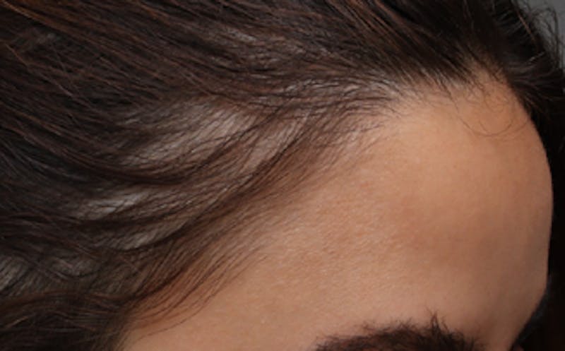 Patient FuhsWr8iQCqKK9mGjpITgg - Hair Restoration Before & After Photos