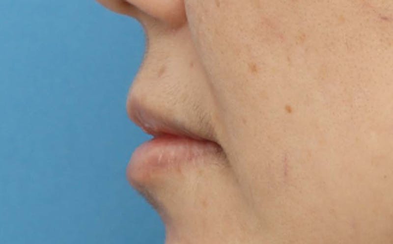 Lip Surgery Before & After Gallery - Patient 362755 - Image 8
