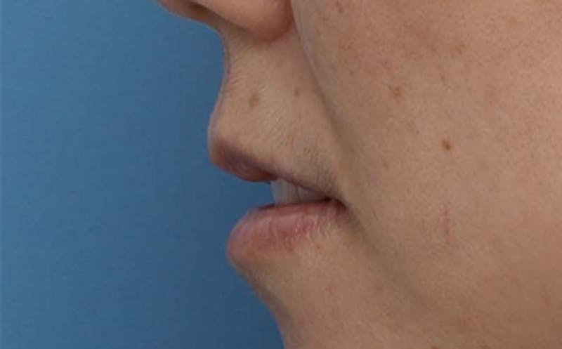 Lip Surgery Before & After Gallery - Patient 362755 - Image 7