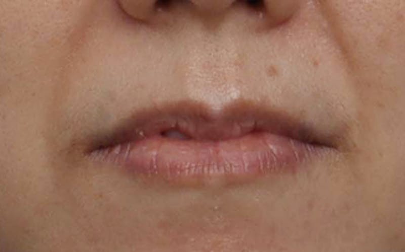 Patient Kn3HPinHQxqICpoCyenKYA - Lip Enhancement Before & After Photos
