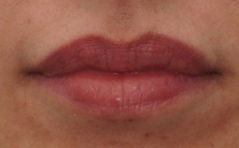 Lip Surgery Before & After Gallery - Patient 100740 - Image 4